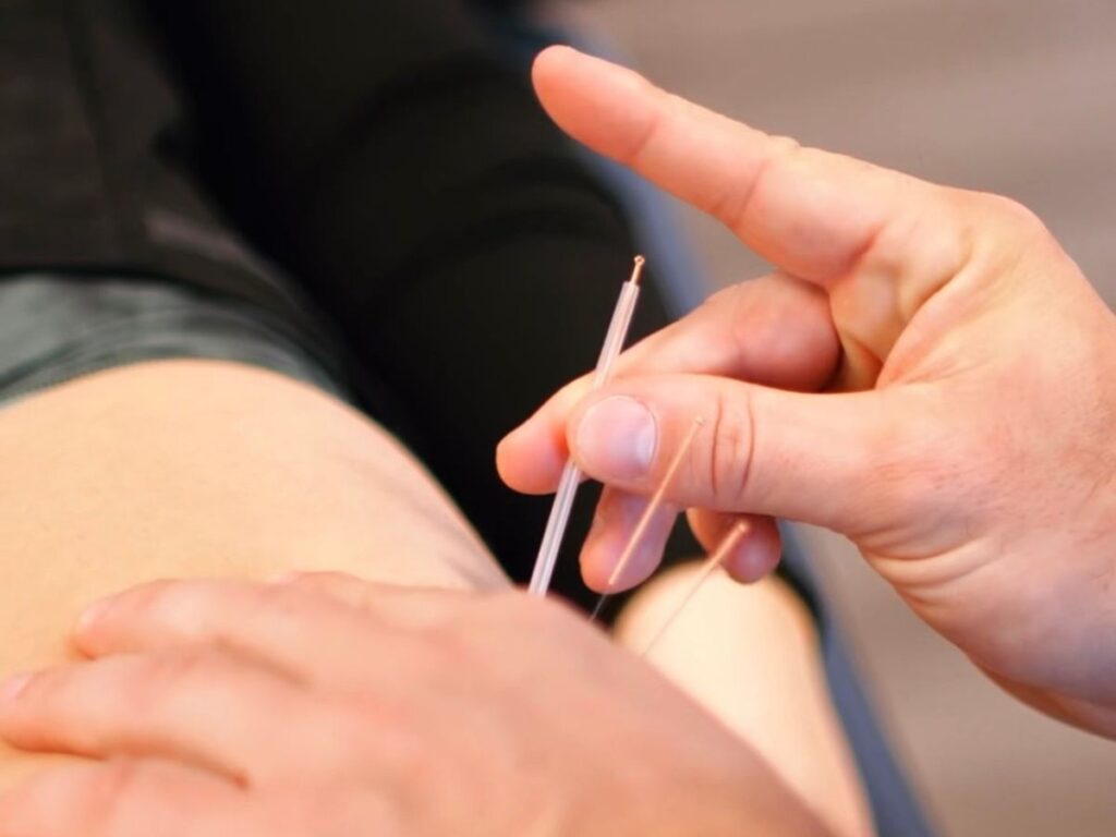 Aiguilles sèches en physiothérapie à Sainte-Foy pour douleurs musculaires